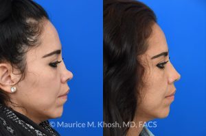 Photo of a patient before and after a procedure. saddle nose rhinoplasty - This patient had previously undergone an unsuccessful rhinoplasty surgery with cadaver rib cartilage graft. She had developed a saddle collapse of her nose and loss of nasal tip definition. Her own rib and temporalis fascia was used to reconstruct the nose. She is ecstatic with her results at 6 months post op. 