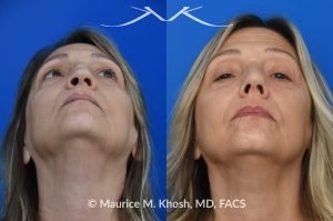 Photo of a patient before and after a procedure. Saddle Nose - Saddle nose nasal deformity due to large septum perforation and loss of bridge and tip support. The deformity was reconstructed utilizing the patient's own rib cartilage which was carved to recreate a natural nose that looks better and functions better.