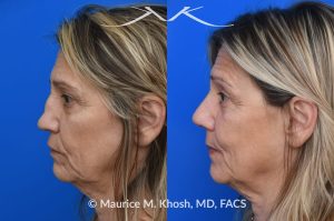 Photo of a patient before and after a procedure. Saddle Nose - Saddle nose nasal deformity due to large septum perforation and loss of bridge and tip support. The deformity was reconstructed utilizing the patient's own rib cartilage which was carved to recreate a natural nose that looks better and functions better.