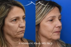 Photo of a patient before and after a procedure. Saddle Nose - Saddle nose nasal deformity due to large septum perforation and loss of bridge and tip support. The deformity was reconstructed utilizing the patient's own rib cartilage which was carved to recreate a natural nose that looks better and functions better.