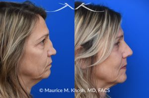 Photo of a patient before and after a procedure. Saddle Nose - Saddle nose nasal deformity due to large septum perforation and loss of bridge and tip support. The deformity was reconstructed utilizing the patient's own rib cartilage which was carved to recreate a natural nose that looks better and functions better.