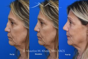 Photo of a patient before and after a procedure. Saddle Nose - Saddle nose nasal deformity due to large septum perforation and loss of bridge and tip support. The deformity was reconstructed utilizing the patient's own rib cartilage which was carved to recreate a natural nose that looks better and functions better.